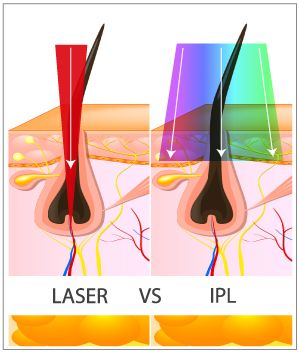 What kind of hair removal mach3