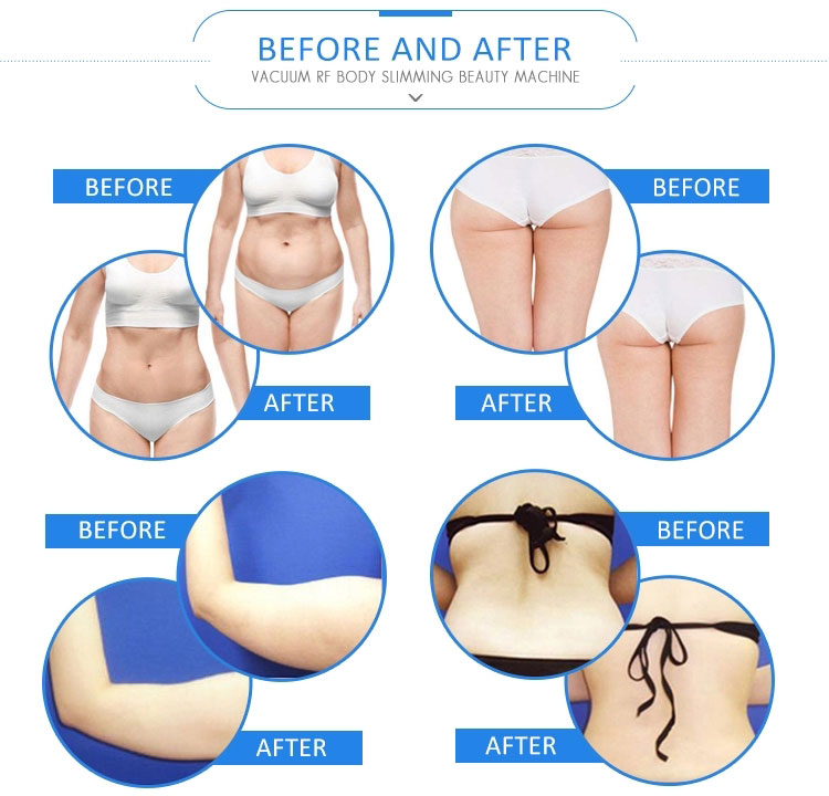 Velashape 3 पोर्टेबल -5